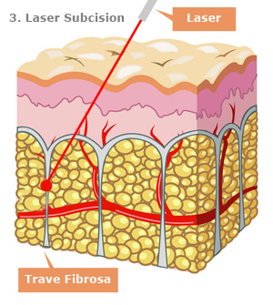 Laser Subcision